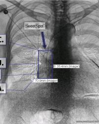 Dual energy CXR. Another variation in Sweet Spot™ dimensions