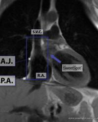 Unenhanced coronal MRI demonstrating same anatomy as coronal enhanced CT