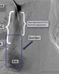 Example of how S.V.C. can be very long in some patients. Right-sided V.A.D. contrast injection.