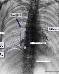 Dual energy CXR. Example of V.A.D. at center of box. I.E. CAJ.