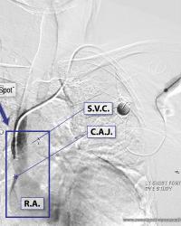 Left-sided chest port S.V.C. gram (mild fibrin sleeve at distal catheter)