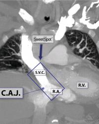 Enhanced coronal CT reconstruction. Sweet Spot™ box can be tilted as patient anatomy dictates.