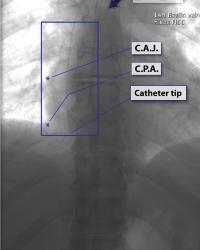 Left-sided access - The catheter can still be very vertical in S.V.C and R.A.