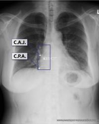 C.A.J. ≈ 4-5 cm below carina - Most patients, most inspiratory CXR's.