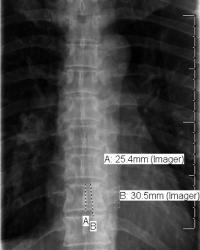 "Vertebral body is internal ruler." Dorsal spine X-ray average 2.5cm height lower dorsal area. 3cm = distance between adjacent superior (or inferior) plates.