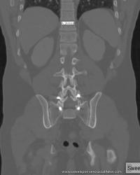 Coronal reformation CT. Example of average height of dorsal vertebral body ≈ 2.5cm "internal ruler."