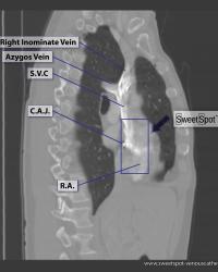 Sagittal CT reconstruction