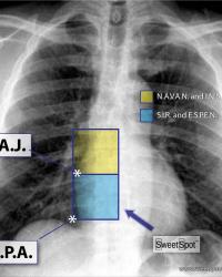 Societal recommendations for V.A.D. catheter tip location