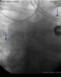 Two mistakes - #1 Subclavin vein puncture, #2 Tip of catheter in upper SVC.